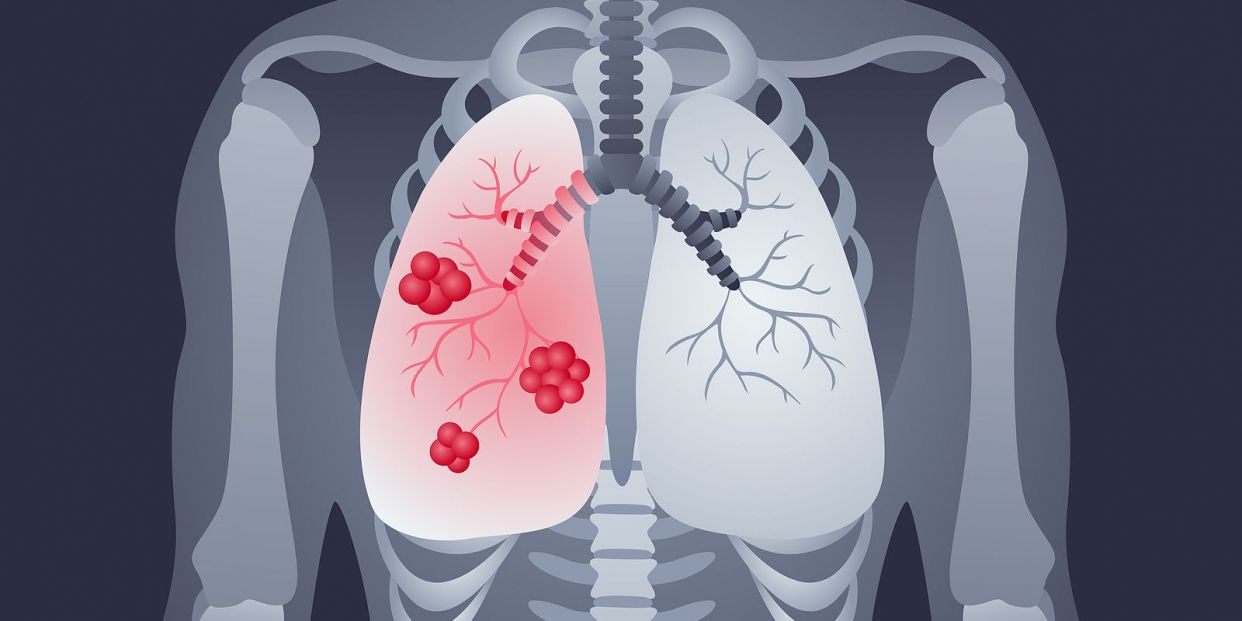 A powermunotherapy power in lung cancer