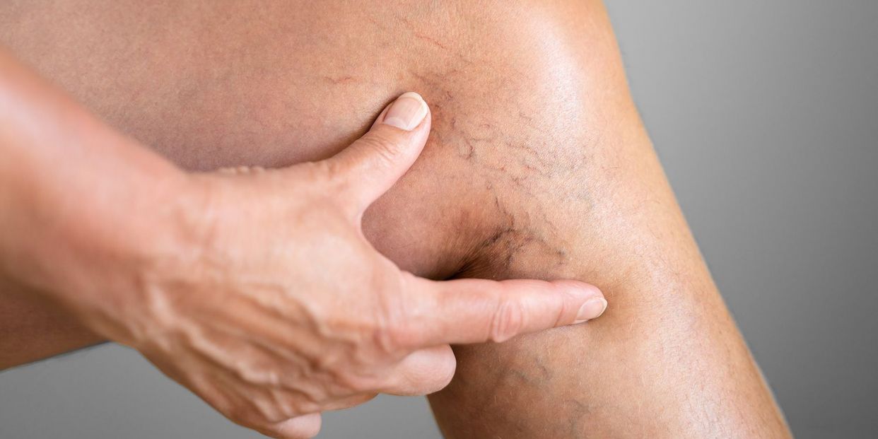 Varicose veins double the risk of heart failure