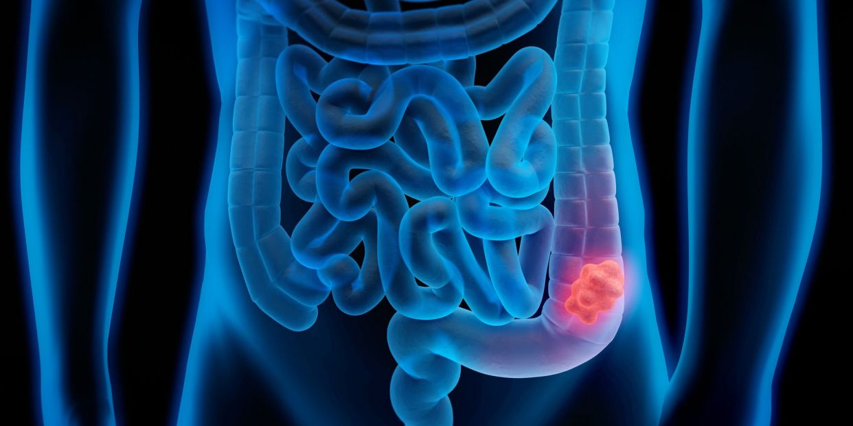 They discover a key protein in colorectal cancer