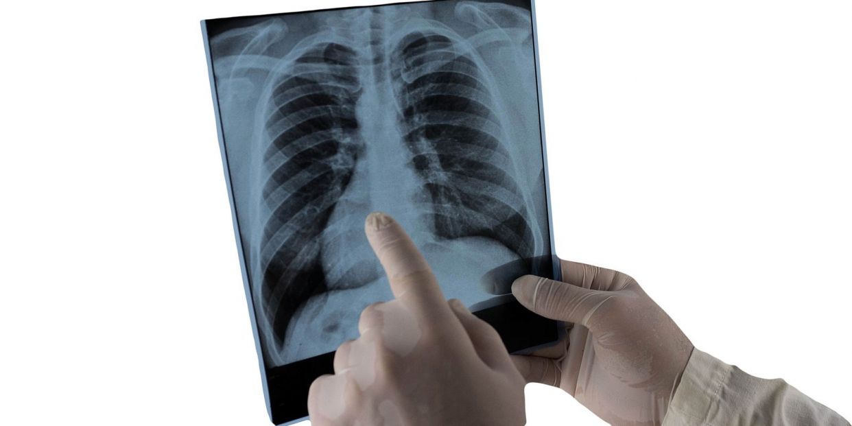 Is there an age limit for a lung transplant?